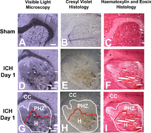 Visualizations of brain tissues help indicate the toxic iron pathways following haemorrhagic stroke. This data is vital to developing effective treatments for this severe type of stroke.