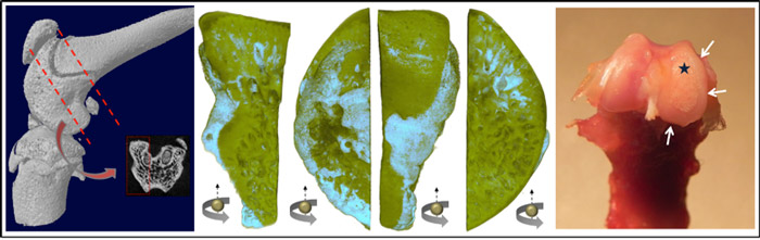 Figure: 3D images collected at the CLS showing distribution of strontium tracer (light blue) in the bone particularly at the marginal osteophytes (bone spurs) and the subchondral bone. The image at the right shows some microscopic features of an osteoarthritic bone namely osteophyte formation (white arrows) and destruction of the articular cartilage in the operated side of the femoral condyle (star) where underlying bone is exposed. The associated area showed a significant accumulation of the tracer in the respective 3D distribution map of strontium.